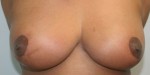 Breast Reduction (Reduction Mammaplasty)