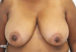 Breast Reduction (Reduction Mammaplasty)