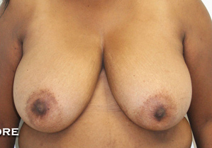Breast Reduction (Reduction Mammaplasty)
