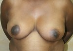 Breast Reduction (Reduction Mammaplasty)
