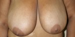 Breast Reduction (Reduction Mammaplasty)