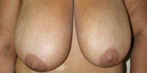 Breast Reduction (Reduction Mammaplasty)