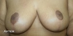 Breast Reduction (Reduction Mammaplasty)