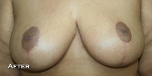 Breast Reduction (Reduction Mammaplasty)