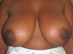 Breast Reduction (Reduction Mammaplasty)