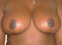Breast Reduction (Reduction Mammaplasty)