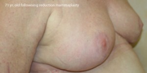 Breast Reduction (Reduction Mammaplasty)