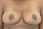 Breast Reduction (Reduction Mammaplasty)