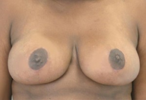 Breast Reduction (Reduction Mammaplasty)