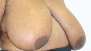 Breast Reduction (Reduction Mammaplasty)