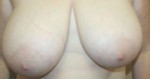 Breast Reduction (Reduction Mammaplasty)