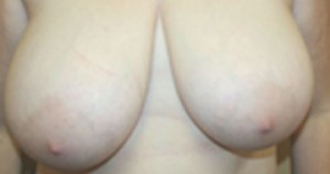 Breast Reduction (Reduction Mammaplasty)