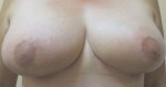 Breast Reduction (Reduction Mammaplasty)