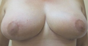 Breast Reduction (Reduction Mammaplasty)