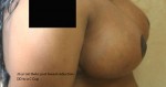 Breast Reduction (Reduction Mammaplasty)