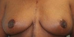 Breast Reduction (Reduction Mammaplasty)