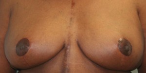 Breast Reduction (Reduction Mammaplasty)