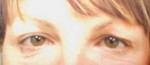 Eyelid Surgery (Blepharoplasty)