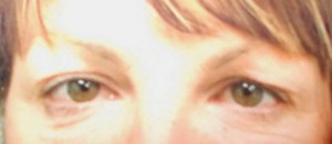 Eyelid Surgery (Blepharoplasty)