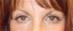 Eyelid Surgery (Blepharoplasty)