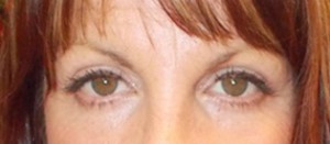 Eyelid Surgery (Blepharoplasty)