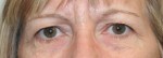 Eyelid Surgery (Blepharoplasty)