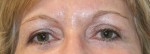 Eyelid Surgery (Blepharoplasty)
