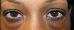 Eyelid Surgery (Blepharoplasty)