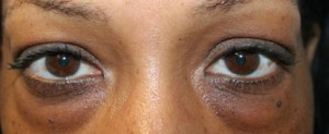 Eyelid Surgery (Blepharoplasty)