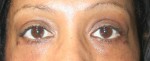 Eyelid Surgery (Blepharoplasty)