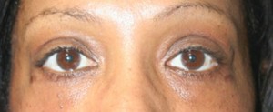 Eyelid Surgery (Blepharoplasty)
