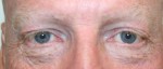 Eyelid Surgery (Blepharoplasty)