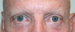 Eyelid Surgery (Blepharoplasty)