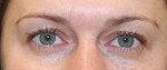 Eyelid Surgery (Blepharoplasty)