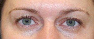 Eyelid Surgery (Blepharoplasty)
