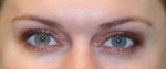 Eyelid Surgery (Blepharoplasty)