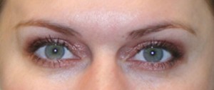Eyelid Surgery (Blepharoplasty)