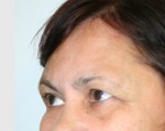 Eyelid Surgery (Blepharoplasty)