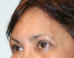 Eyelid Surgery (Blepharoplasty)
