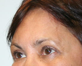 Eyelid Surgery (Blepharoplasty)