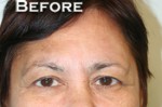 Eyelid Surgery (Blepharoplasty)