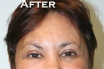 Eyelid Surgery (Blepharoplasty)