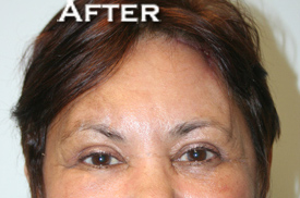 Eyelid Surgery (Blepharoplasty)