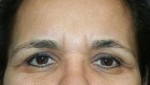 Eyelid Surgery (Blepharoplasty)