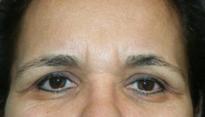 Eyelid Surgery (Blepharoplasty)