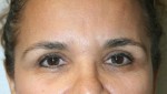 Eyelid Surgery (Blepharoplasty)
