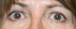 Eyelid Surgery (Blepharoplasty)