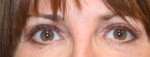 Eyelid Surgery (Blepharoplasty)