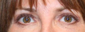 Eyelid Surgery (Blepharoplasty)