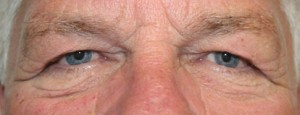 Eyelid Surgery (Blepharoplasty)